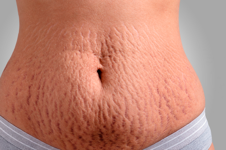 Cirurgia plástica e estética se aliam contra as estrias
