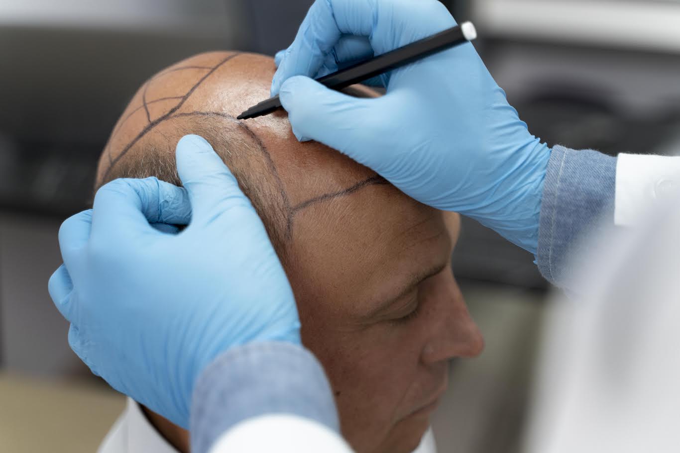 Técnica FUE redefine padrões de transplante capilar moderno